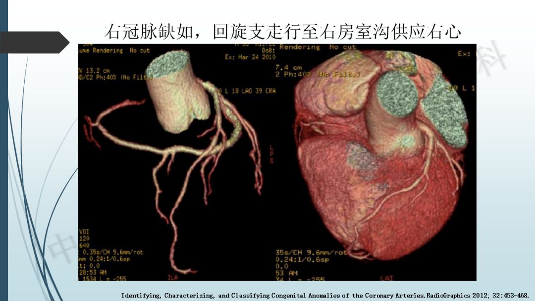 【PPT】冠脉CTA解剖变异