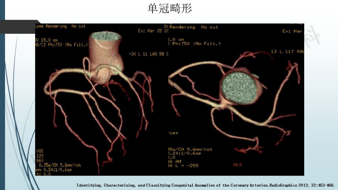 【PPT】冠脉CTA解剖变异