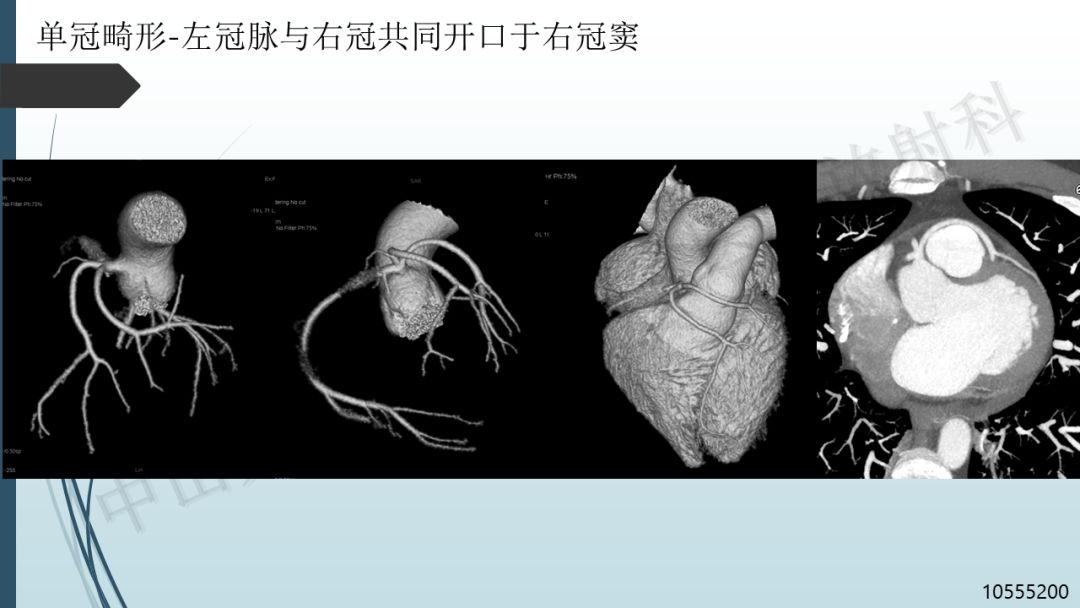 【PPT】冠脉CTA解剖变异