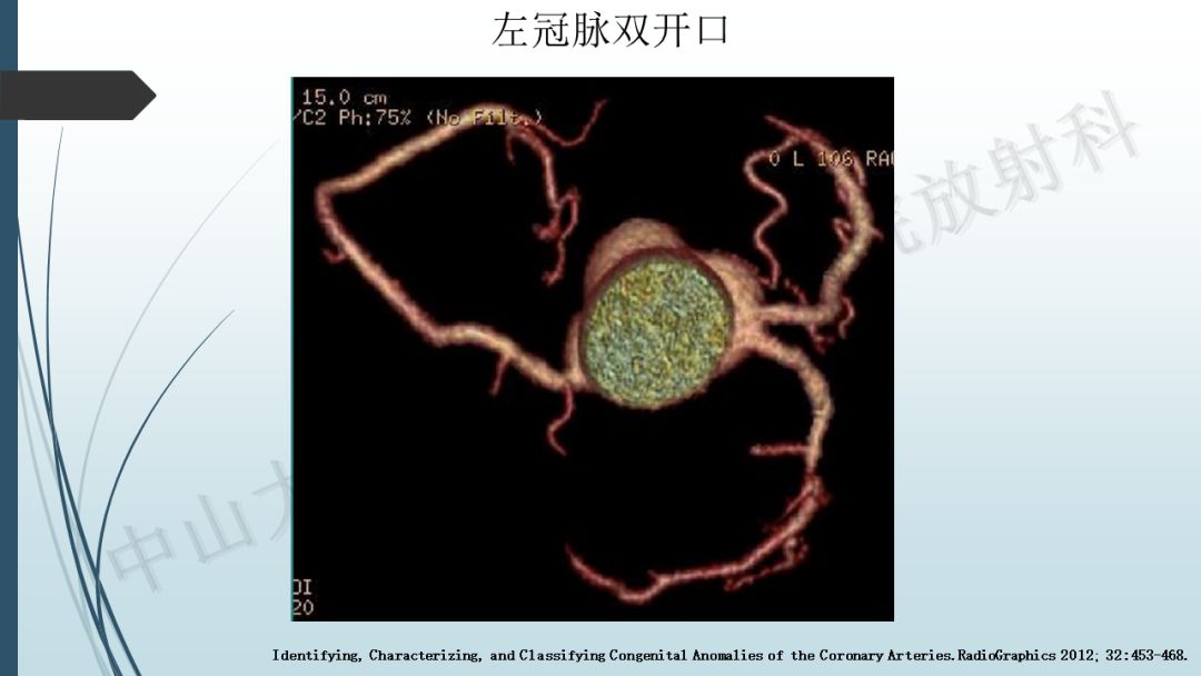 【PPT】冠脉CTA解剖变异