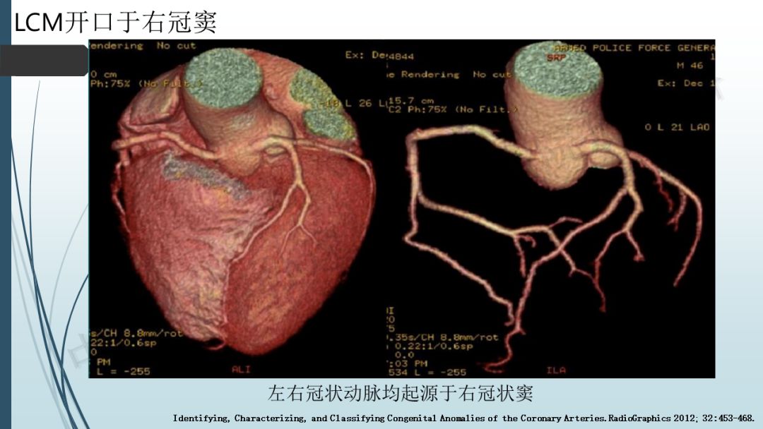 【PPT】冠脉CTA解剖变异