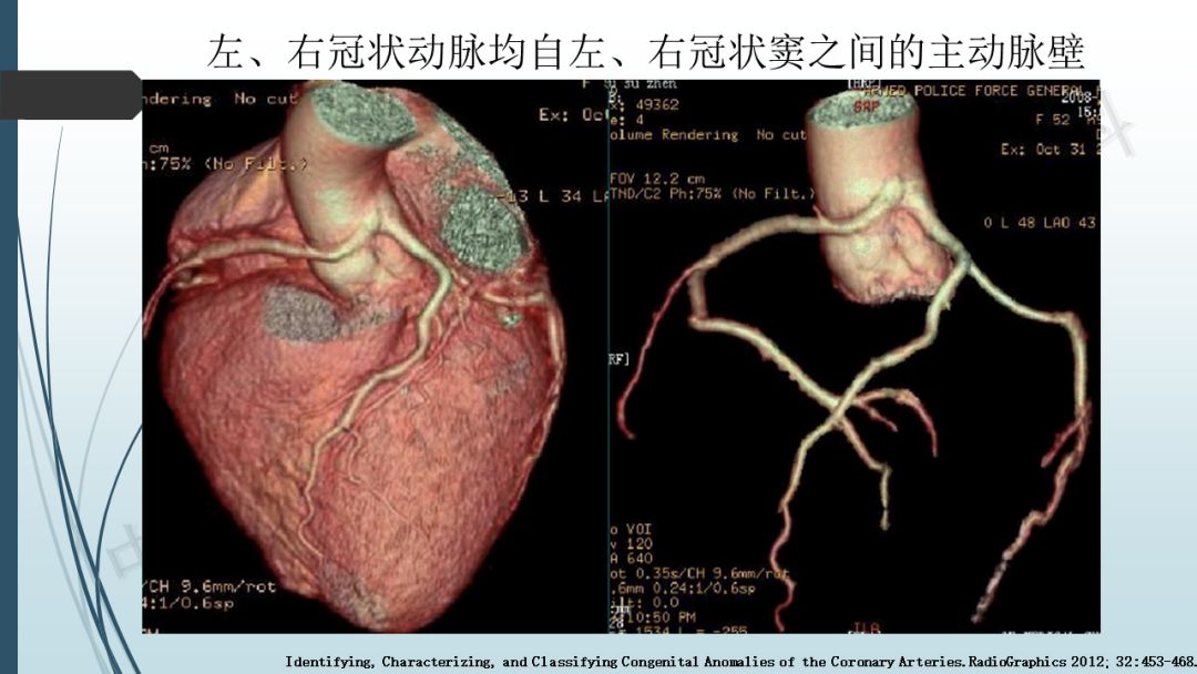 【PPT】冠脉CTA解剖变异