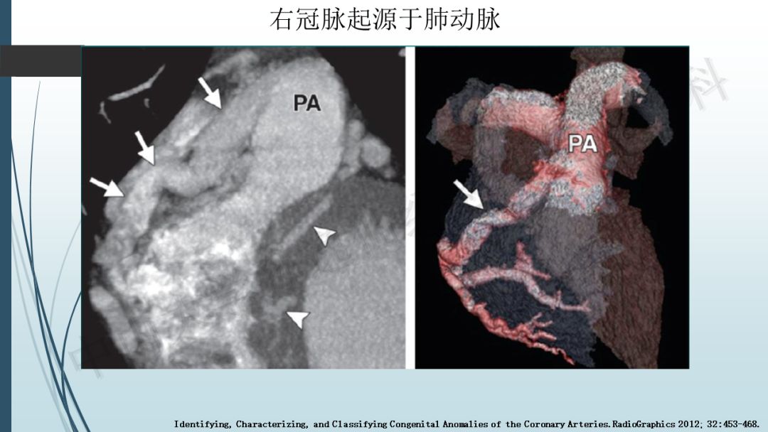 【PPT】冠脉CTA解剖变异