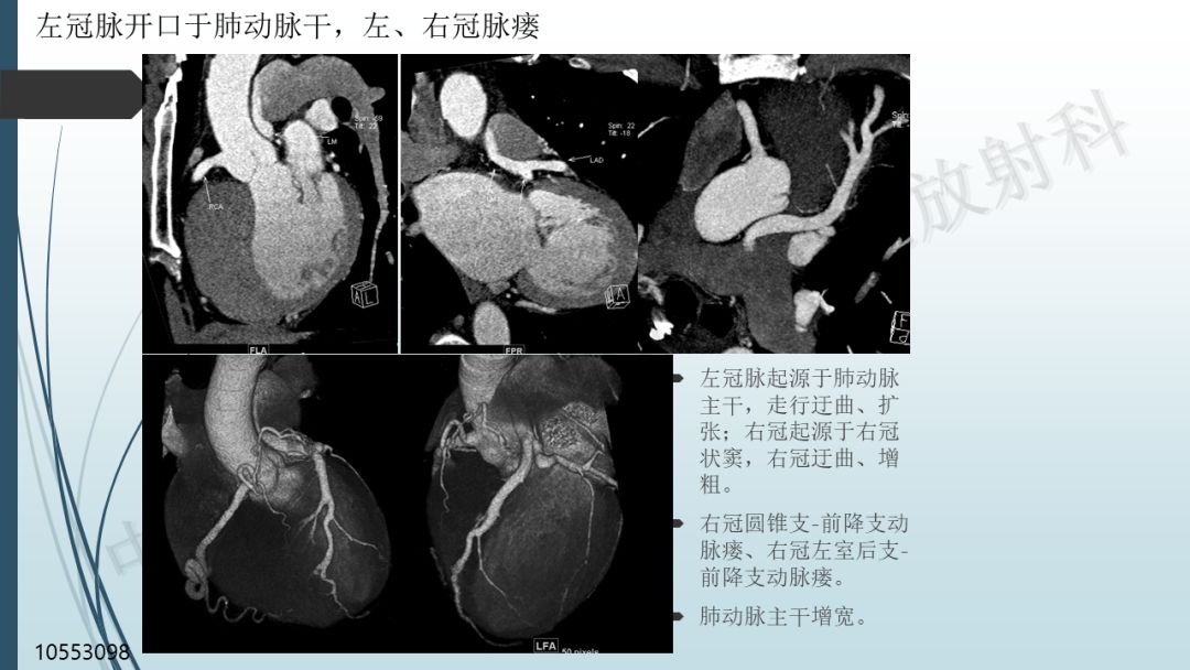 【PPT】冠脉CTA解剖变异