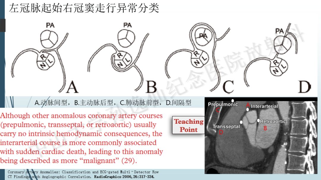 【PPT】冠脉CTA解剖变异