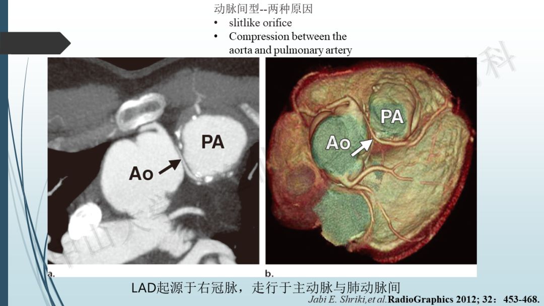 【PPT】冠脉CTA解剖变异