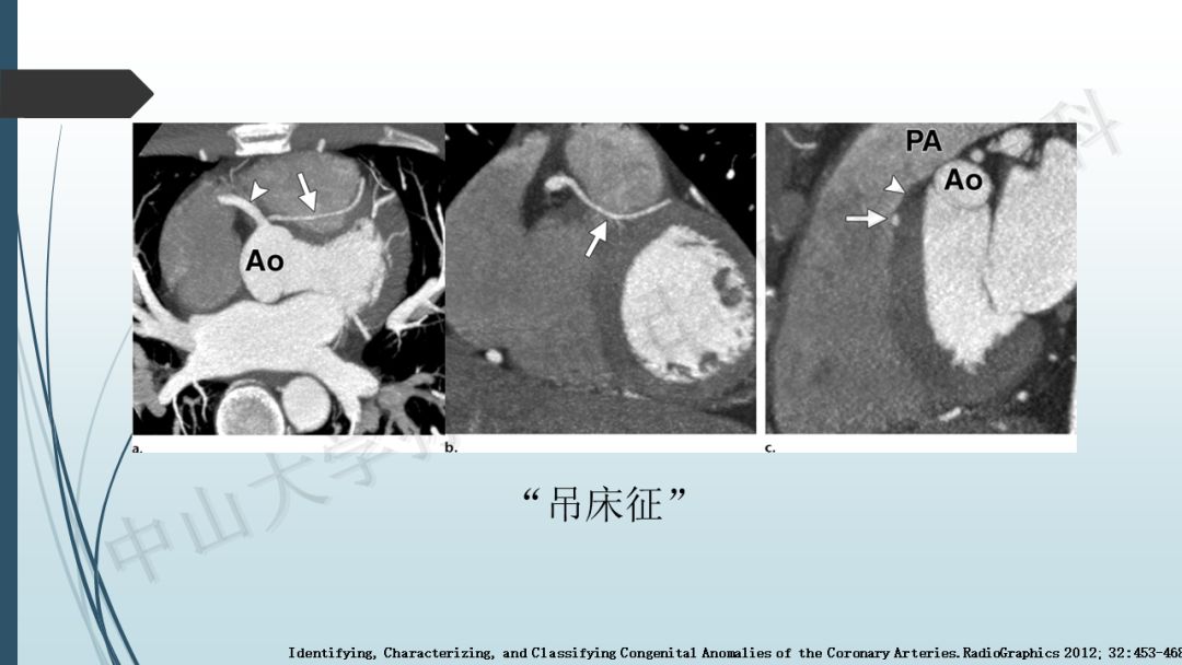 【PPT】冠脉CTA解剖变异