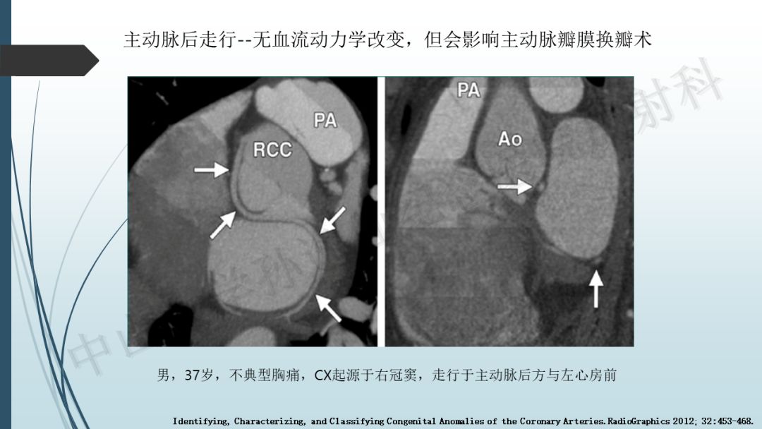 【PPT】冠脉CTA解剖变异