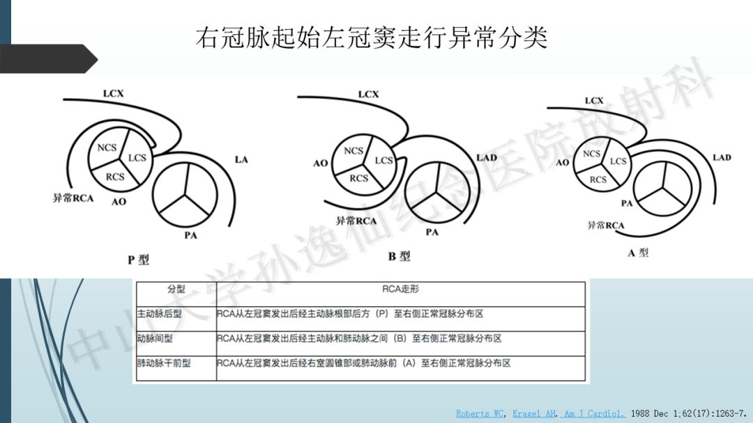 【PPT】冠脉CTA解剖变异