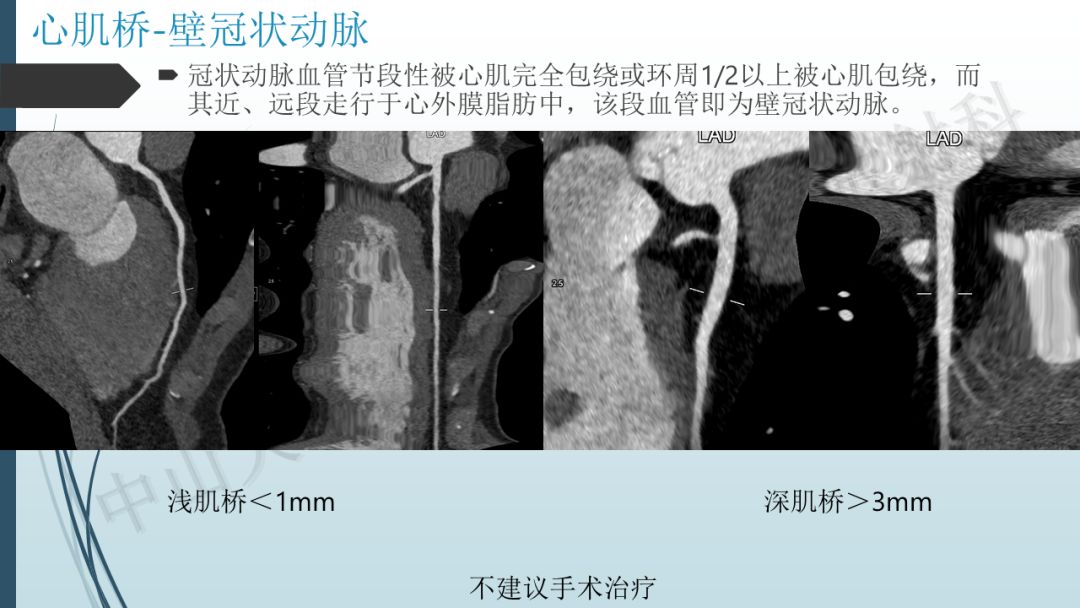 【PPT】冠脉CTA解剖变异