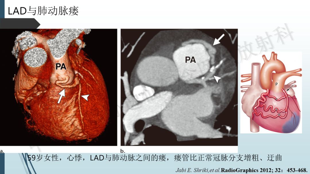 【PPT】冠脉CTA解剖变异