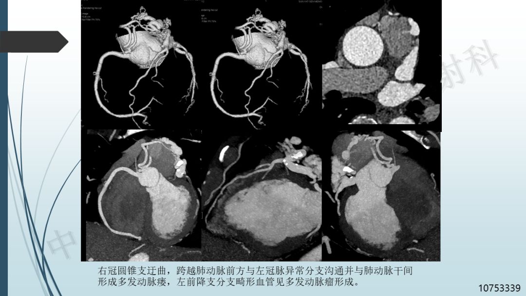 【PPT】冠脉CTA解剖变异