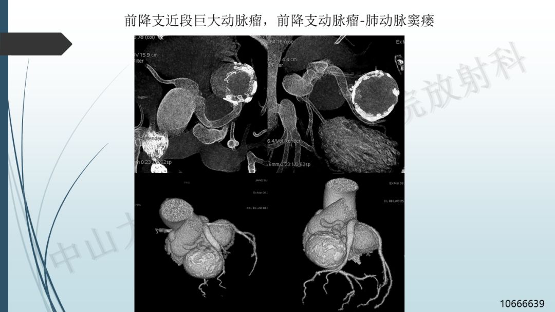 【PPT】冠脉CTA解剖变异