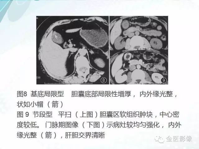 【PPT】胆囊腺肌症