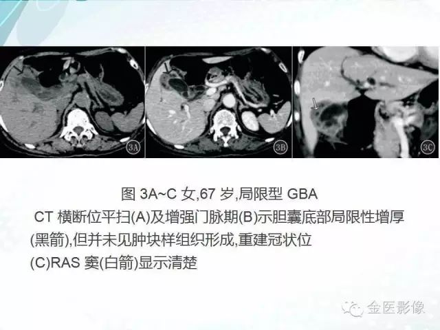 【PPT】胆囊腺肌症