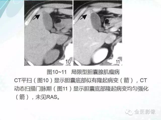 【PPT】胆囊腺肌症