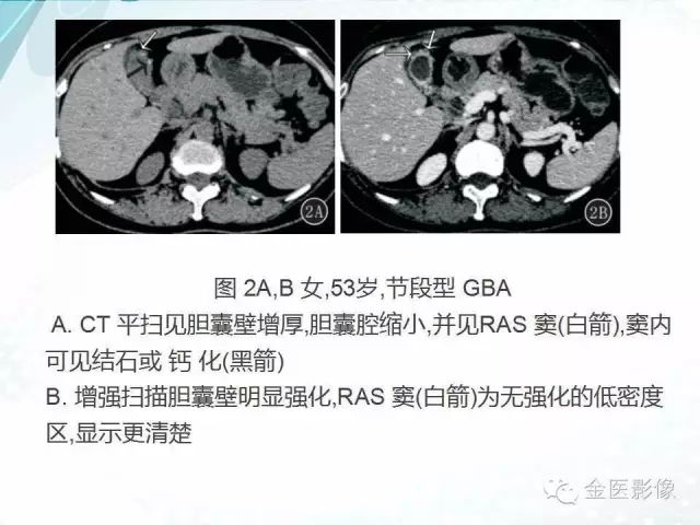【PPT】胆囊腺肌症