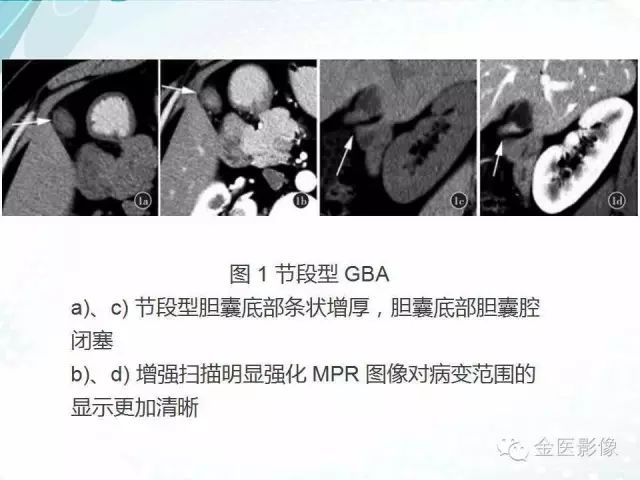 【PPT】胆囊腺肌症