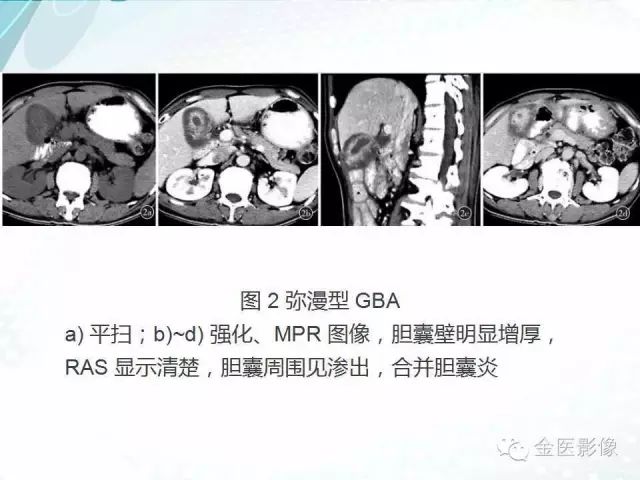 【PPT】胆囊腺肌症