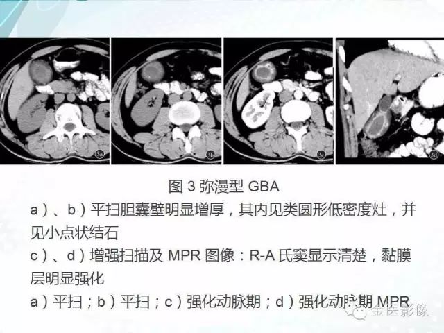 【PPT】胆囊腺肌症