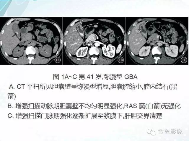 【PPT】胆囊腺肌症