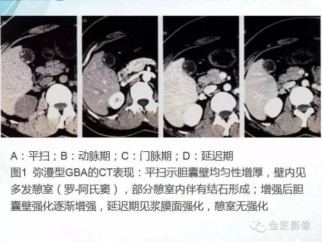 【PPT】胆囊腺肌症