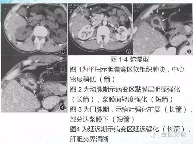 【PPT】胆囊腺肌症