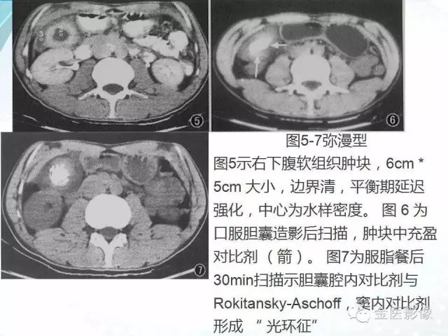 【PPT】胆囊腺肌症