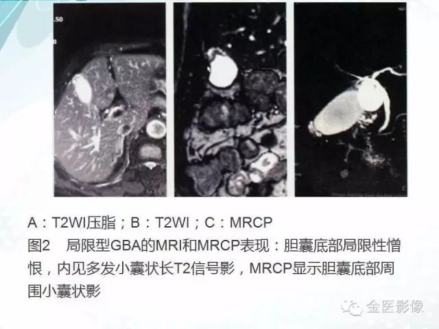 【PPT】胆囊腺肌症