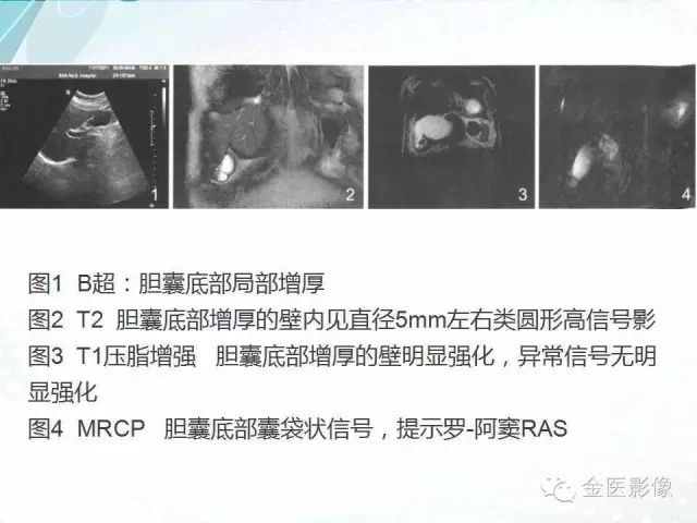 【PPT】胆囊腺肌症
