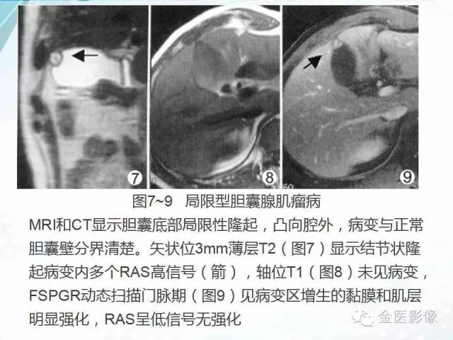 【PPT】胆囊腺肌症