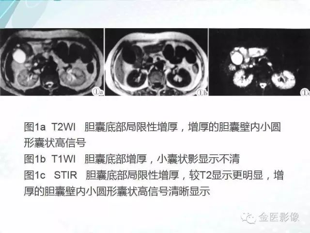 【PPT】胆囊腺肌症