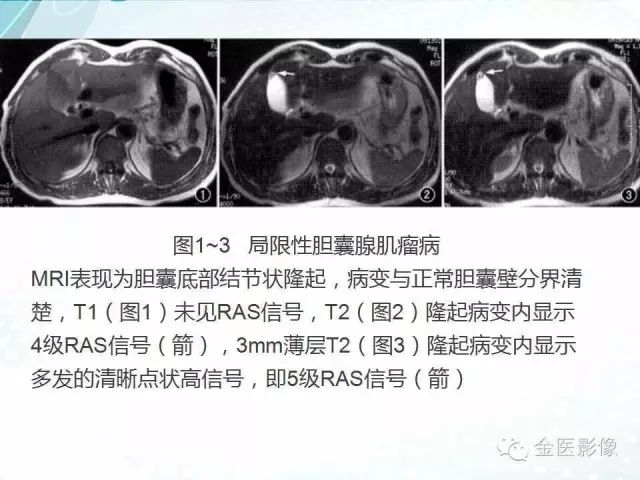 【PPT】胆囊腺肌症