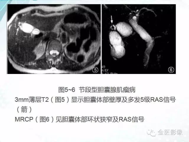 【PPT】胆囊腺肌症