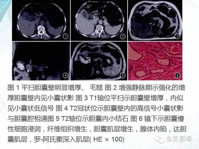 【PPT】胆囊腺肌症