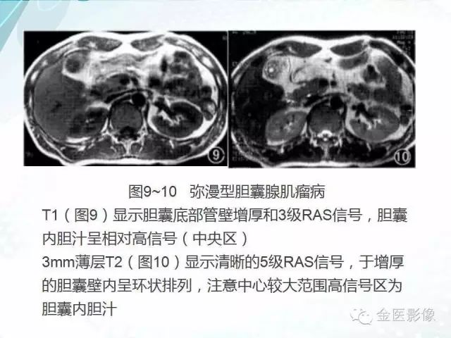 【PPT】胆囊腺肌症