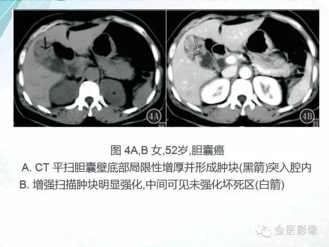 【PPT】胆囊腺肌症