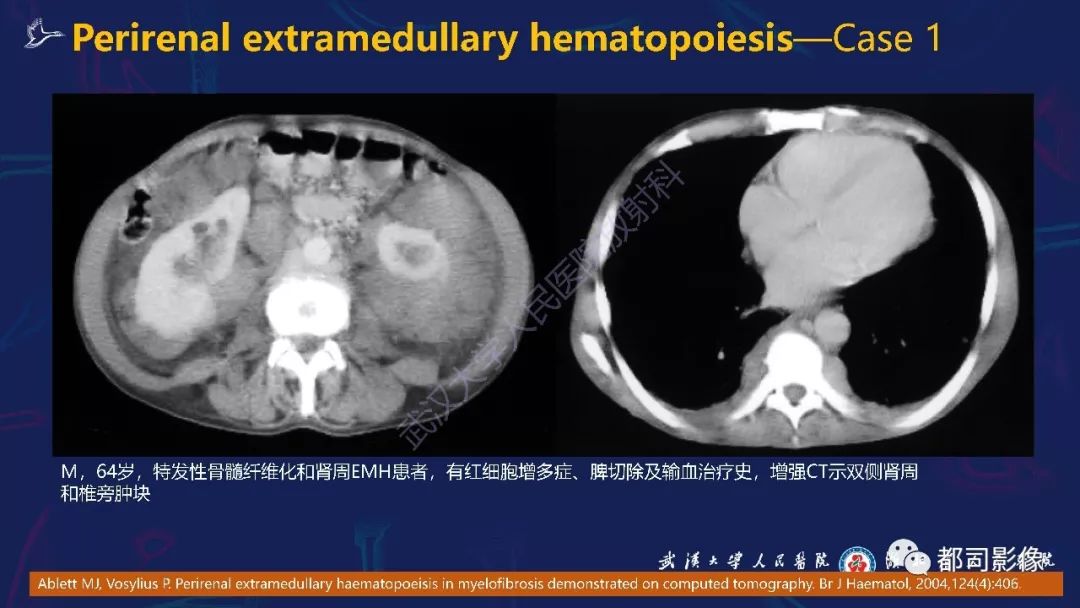 【PPT】肾周髓外造血影像诊断