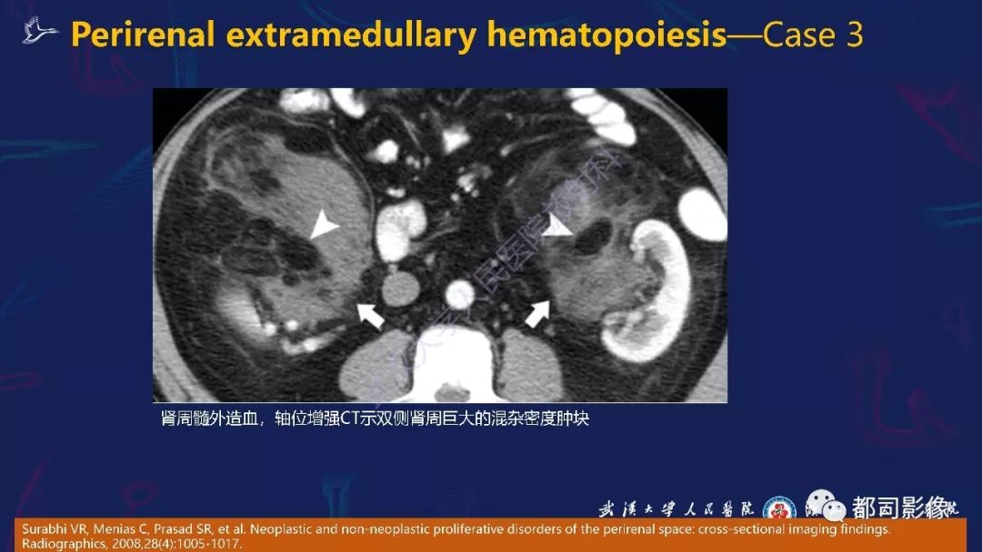 【PPT】肾周髓外造血影像诊断