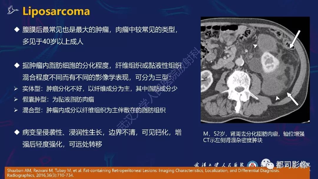 【PPT】肾周髓外造血影像诊断