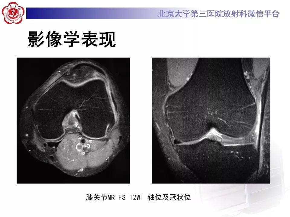 【病例】髂胫束综合征1例MR