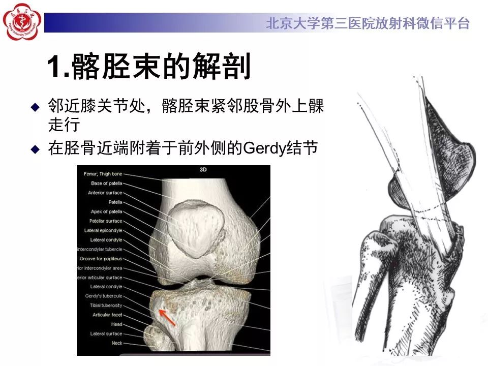 【病例】髂胫束综合征1例MR