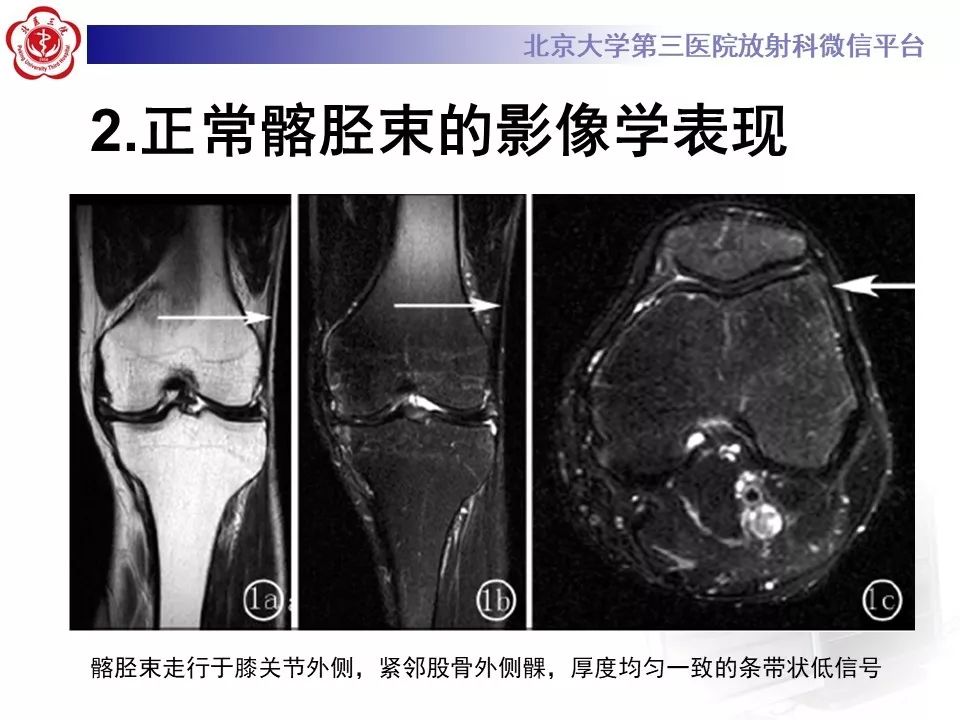 【病例】髂胫束综合征1例MR