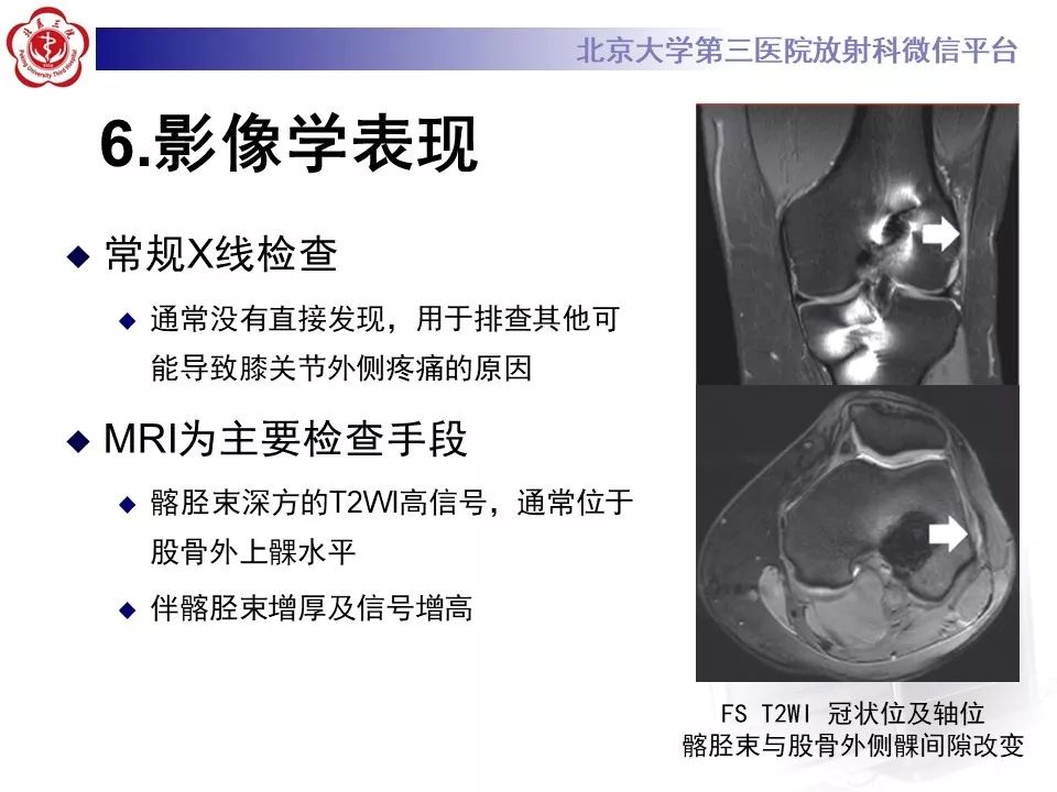 【病例】髂胫束综合征1例MR
