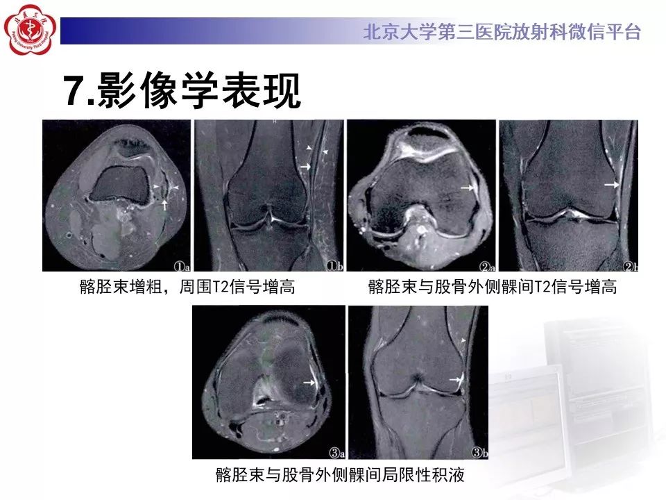 【病例】髂胫束综合征1例MR