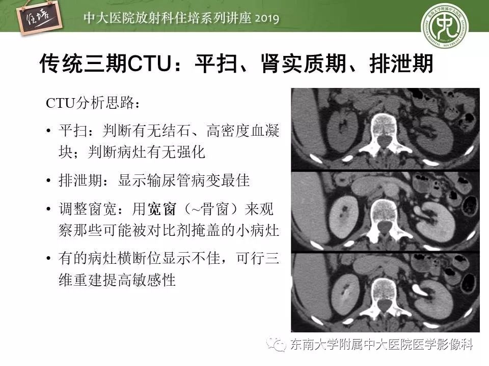 【PPT】血尿的影像分析思路