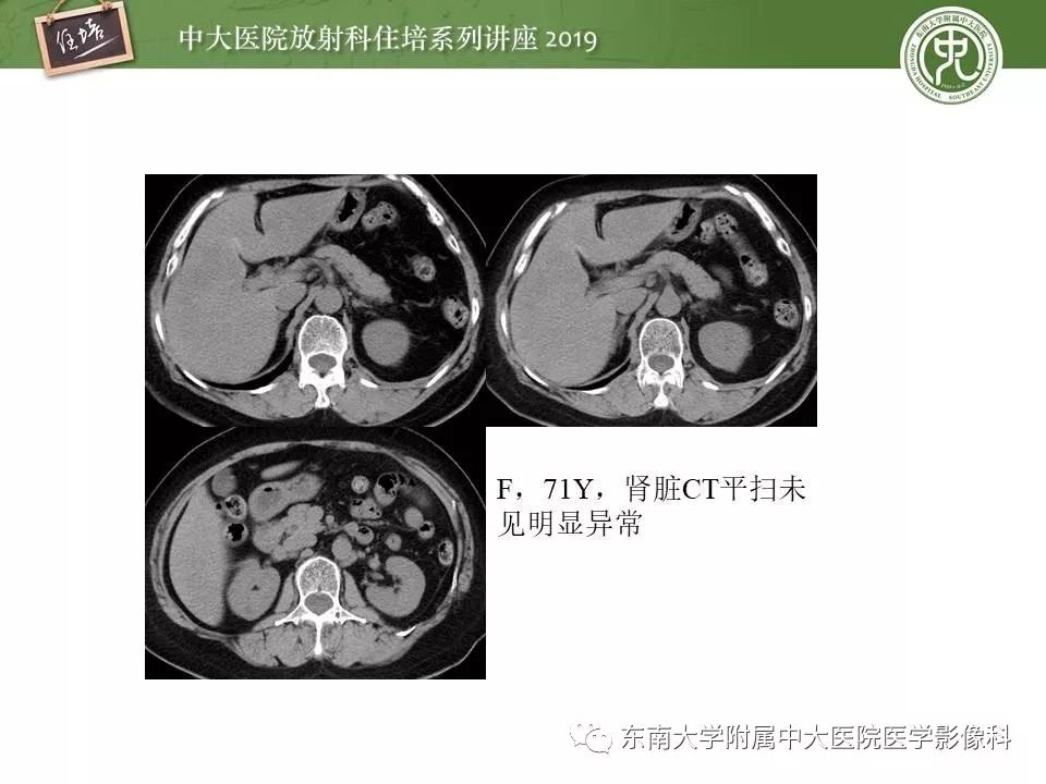 【PPT】血尿的影像分析思路