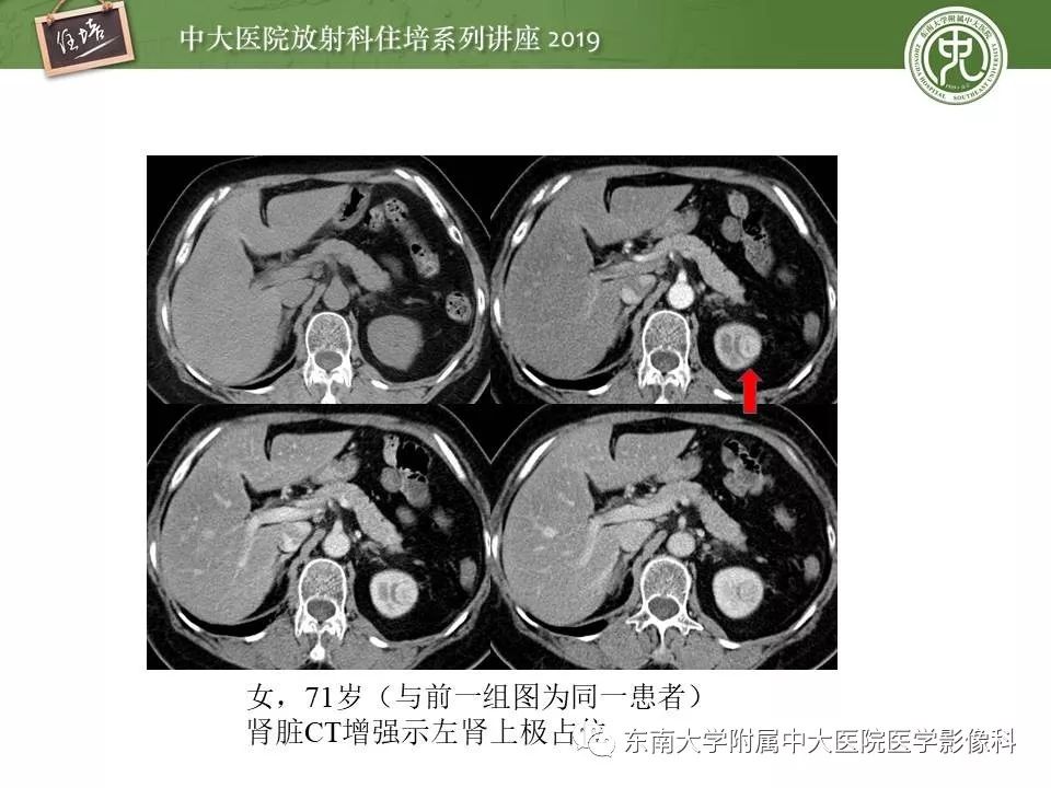 【PPT】血尿的影像分析思路