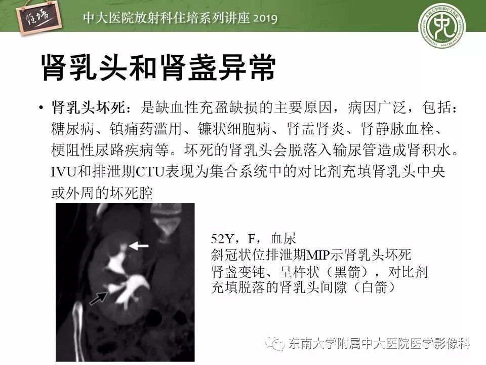 【PPT】血尿的影像分析思路