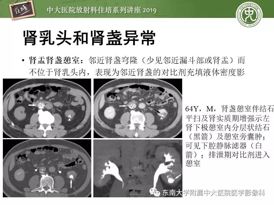 【PPT】血尿的影像分析思路